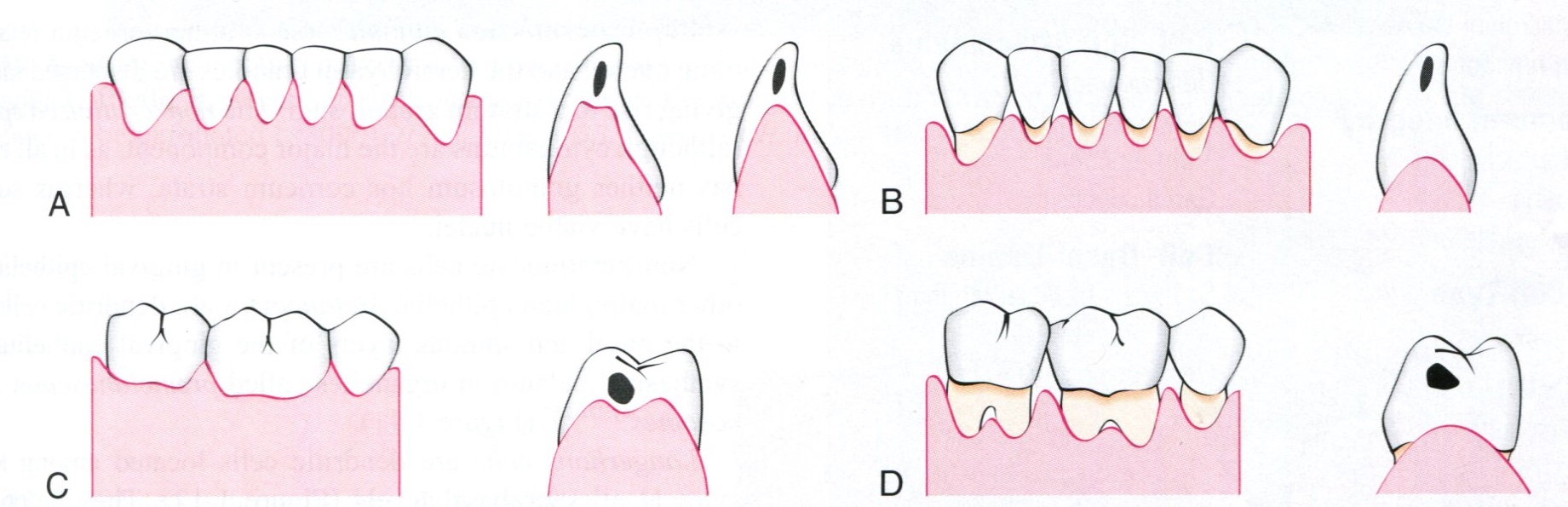     於相邻两牙接触区根方的龈外展隙中,由游离龈和部