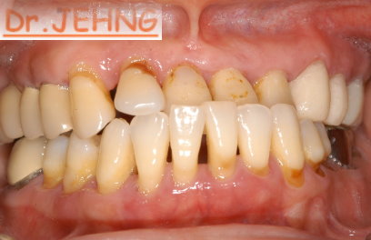 牙周病患沒有植牙之補綴治療