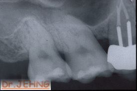 治療後右上後牙x光片1