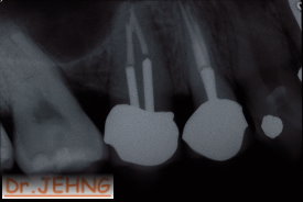 治療後右上後牙x光片2
