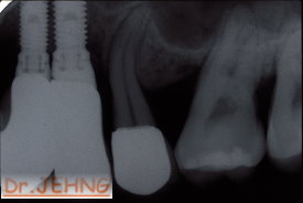 治療後左上後牙x光片1