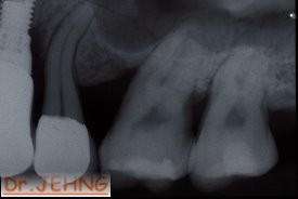 治療後左上後牙x光片2