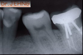 治療後左下後牙x光片2