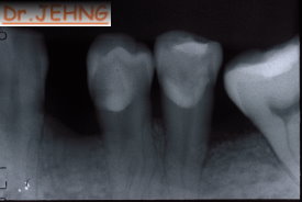治療後左下後牙x光片1