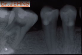 治療後右下後牙x光片2