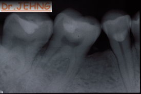 治療後右下後牙x光片1