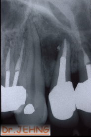 治療後上顎前牙x光片1