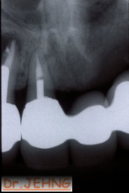 治療後上顎前牙x光片2