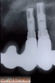 治療後上顎前牙x光片3