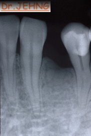治療後下顎前牙x光片3