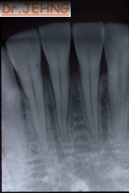 治療後下顎前牙x光片2
