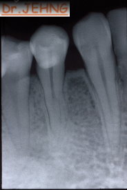 治療後下顎前牙x光片1