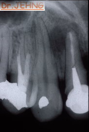 治療前上顎前牙 x光片1