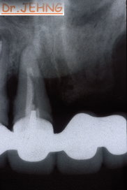 治療前上顎前牙x光片2