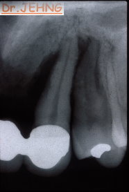 治療前上顎前牙x光片3
