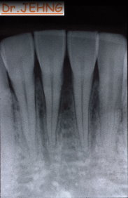 治療前下顎前牙x光片2