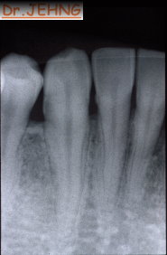 治療前下顎前牙x光片1