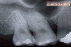 治療前右上後牙x光片1