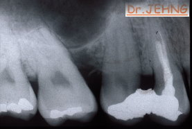 治療前右上後牙x光片2