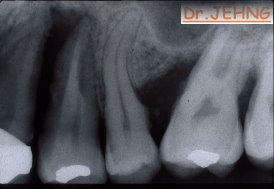 治療前左上後牙x光片1