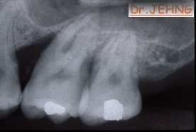 治療前左上後牙x光片2