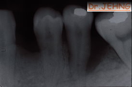治療前左下後牙x光片1