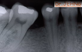 治療前右下後牙x光片2