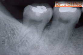 治療前右下後牙x光片1