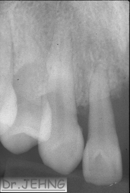 治療前上顎前牙x光片1