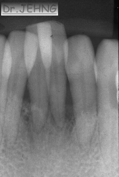 治療前下顎前牙x光片2