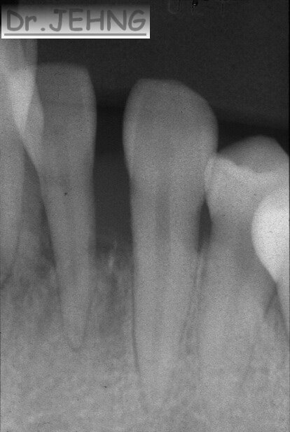 治療前下顎前牙x光片3