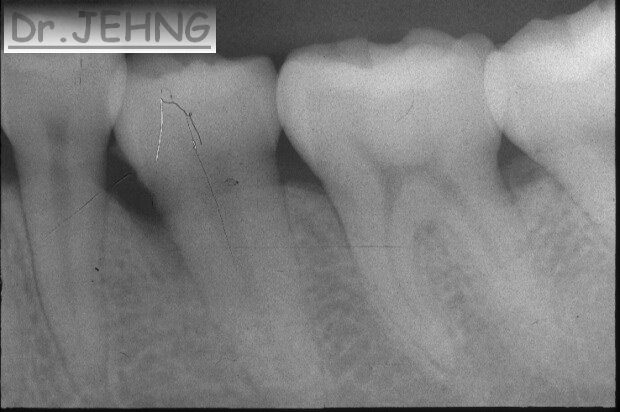 治療前左下後牙x光片1