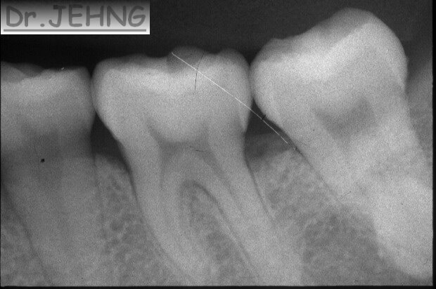 治療前左下後牙x光片2