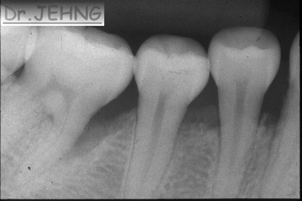 治療前右下後牙x光片1