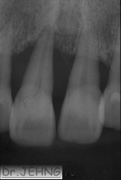 治療前上顎前牙x光片2