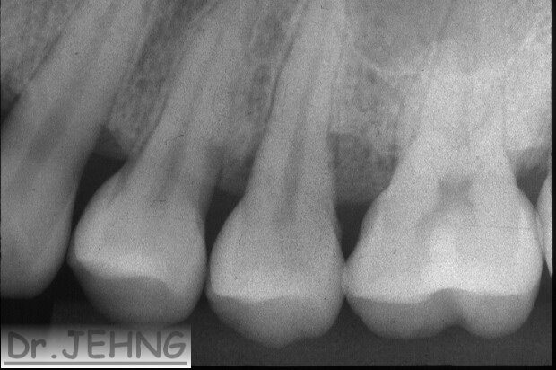 治療前左上後牙x光片1