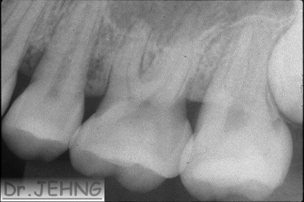 治療前左上後牙x光片2