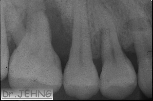 治療前右上後牙x光片2